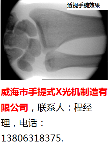 威海市手提式X光机-70-200-透视手腕效果